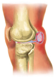 Professional Baker's Cyst treatment