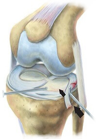 Meniscus Tear Image