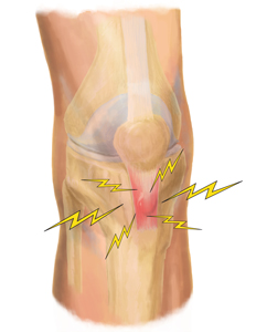 Professional Patellar Tendonitis Treatment