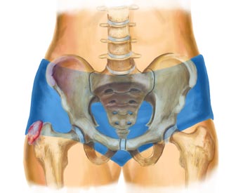 Trochanteric Bursitis Treatment