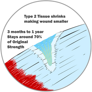 Type 2 Shrinks